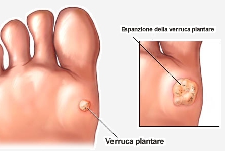 verruche-plantare