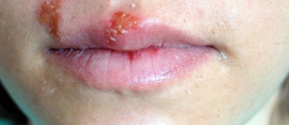 Foto di Herpes Labiale spacciata per tumore delle labbra